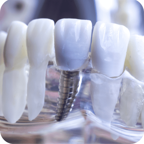 Dental Implant