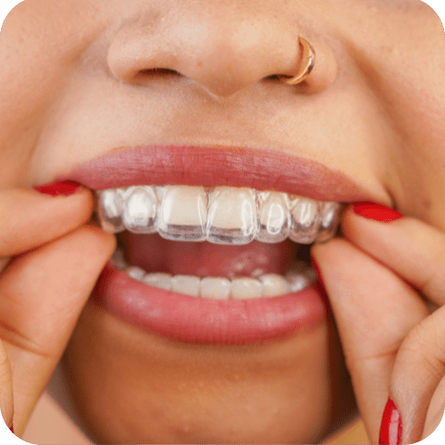 Clear Aligner