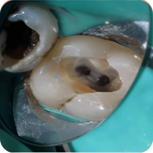 Single Visit RCT