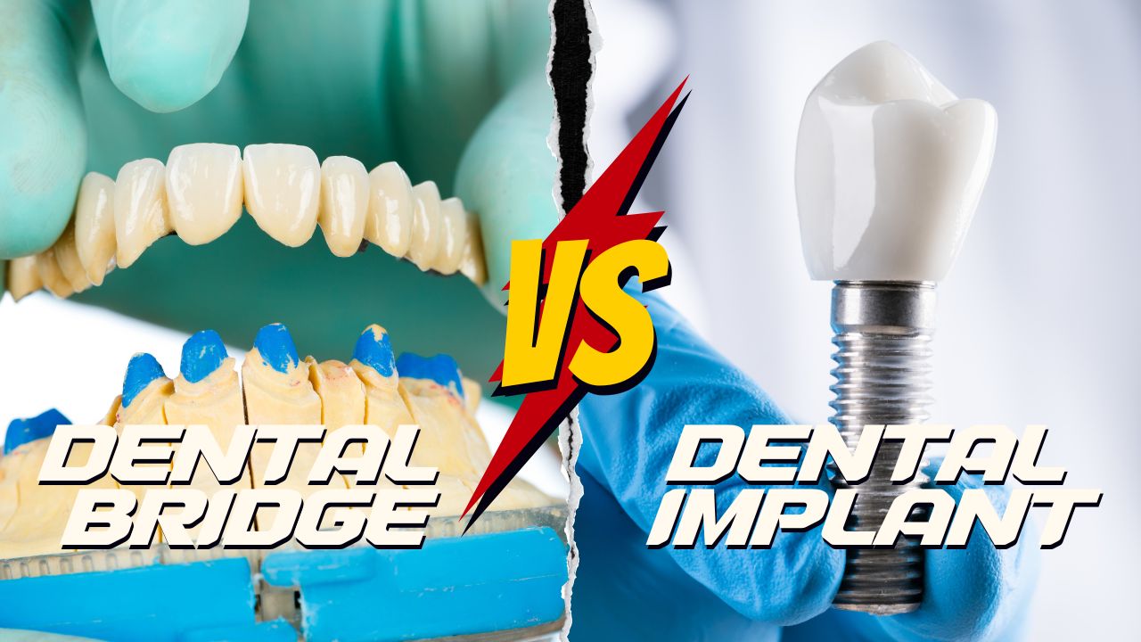 Dental Bridge vs Implant in Nepal: Choosing the Best Option for Your Smile