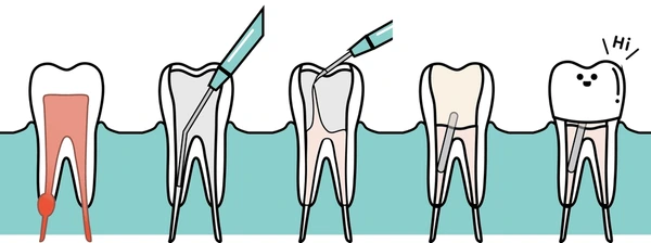 Price of Single Visit Root Canal Treatment in Nepal