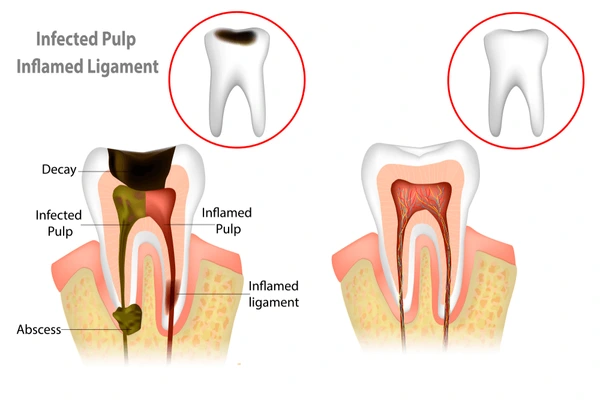 Price of Single Visit Root Canal Treatment in Nepal