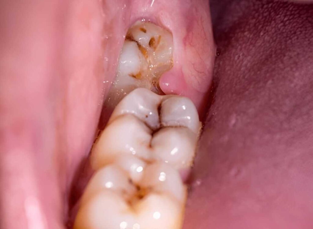 Wisdom tooth removal in nepal 