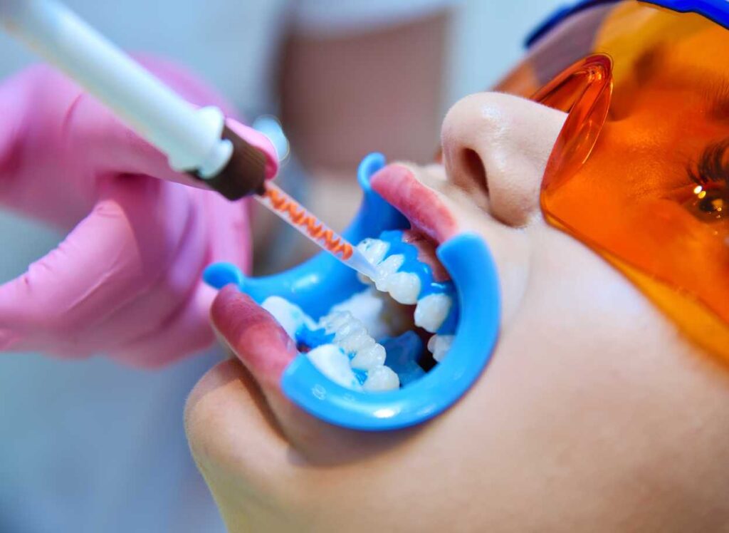 Teeth Bleaching in Nepal