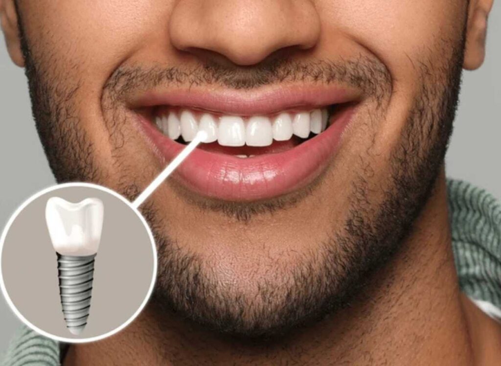 Dental implant at Sparsh dental Clinic, Pulchowk, Lalitpur, Nepal