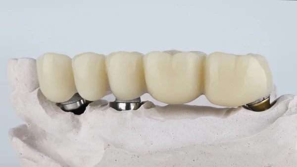 Implant supported tooth bridge in Nepal