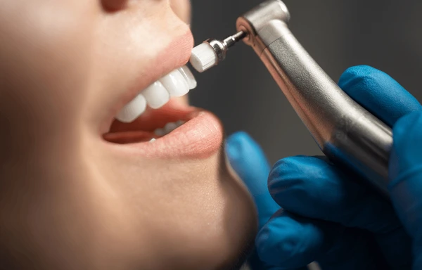 tooth polishing and scaling in Nepal 
