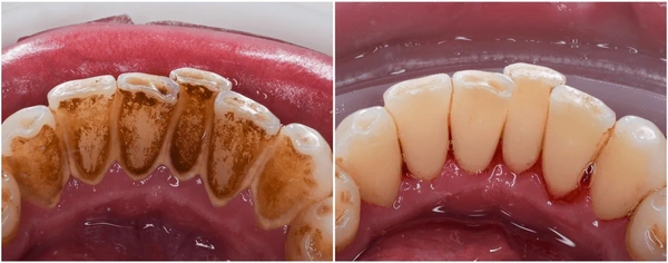tooth polishing and scaling in Nepal 