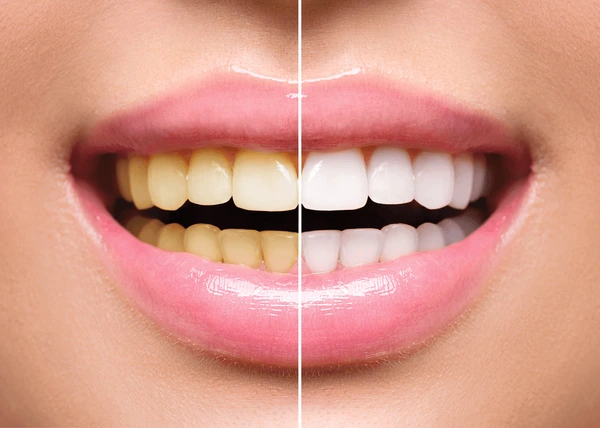 Teeth Whitening in Nepal