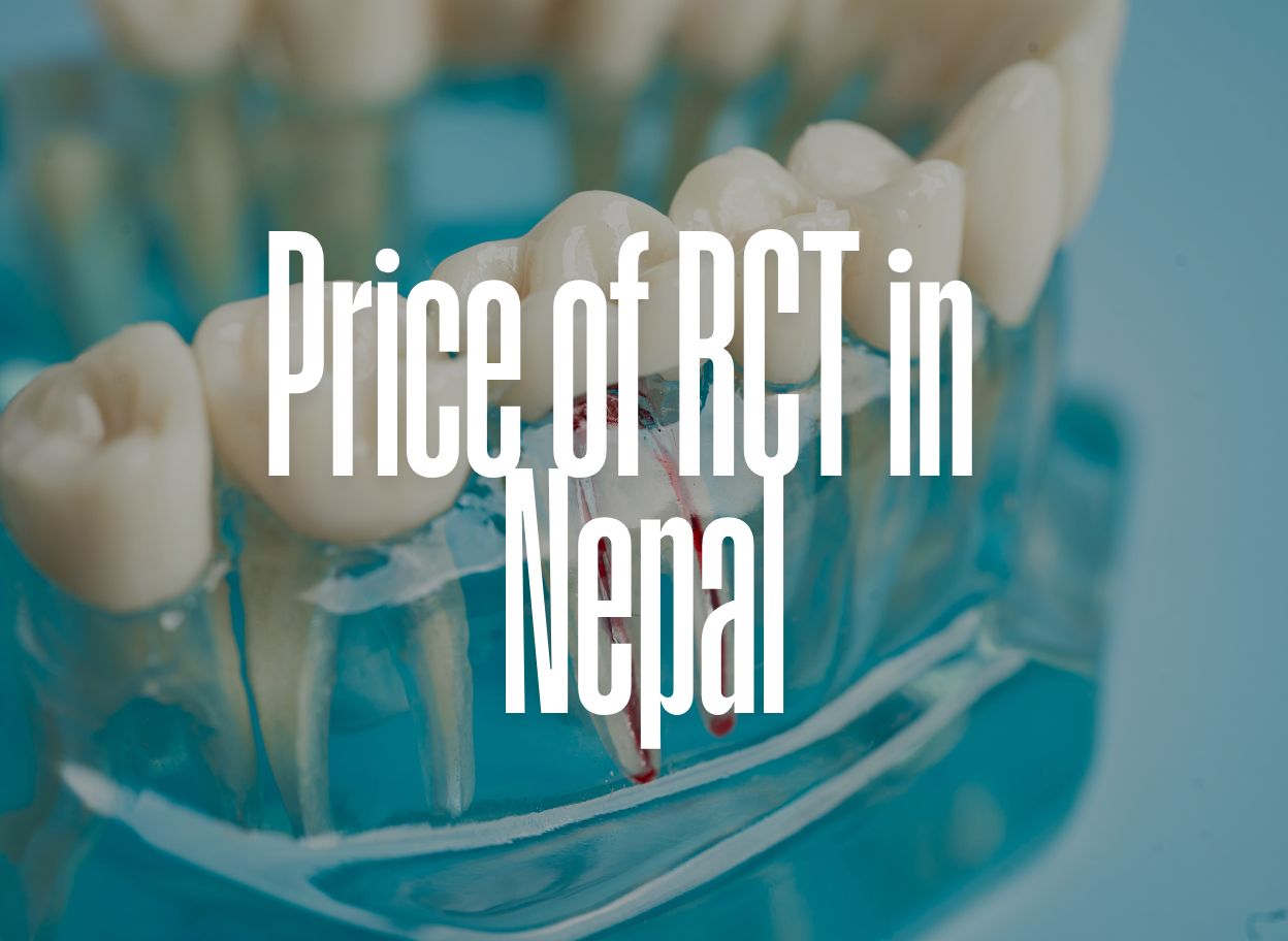 Cost of RCT in Lalitpur – Everything You Need to Know About Root Canal Treatment