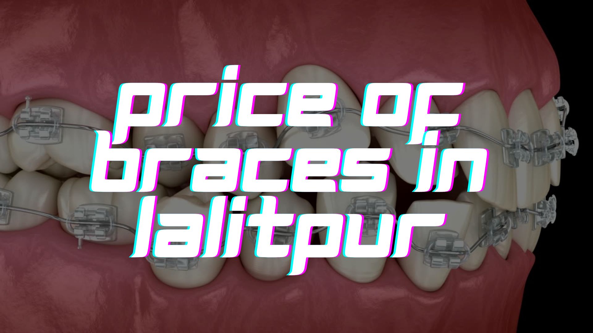 What New? Price of Braces in Lalitpur.