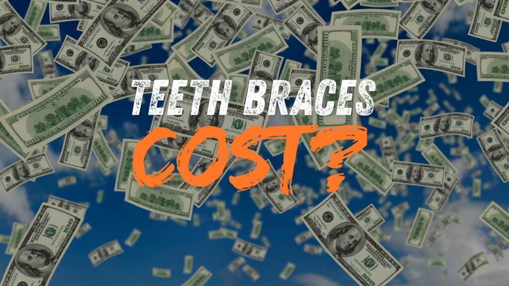 Price of Braces in Lalitpur