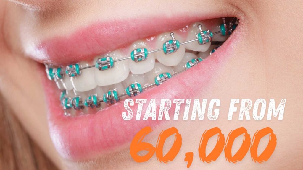 Price of Braces in Lalitpur