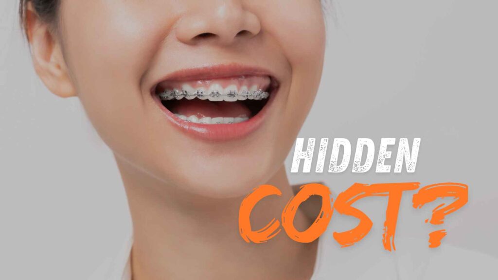 Price of Braces in Lalitpur