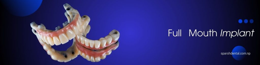 Price of Tooth Implant in Nepal