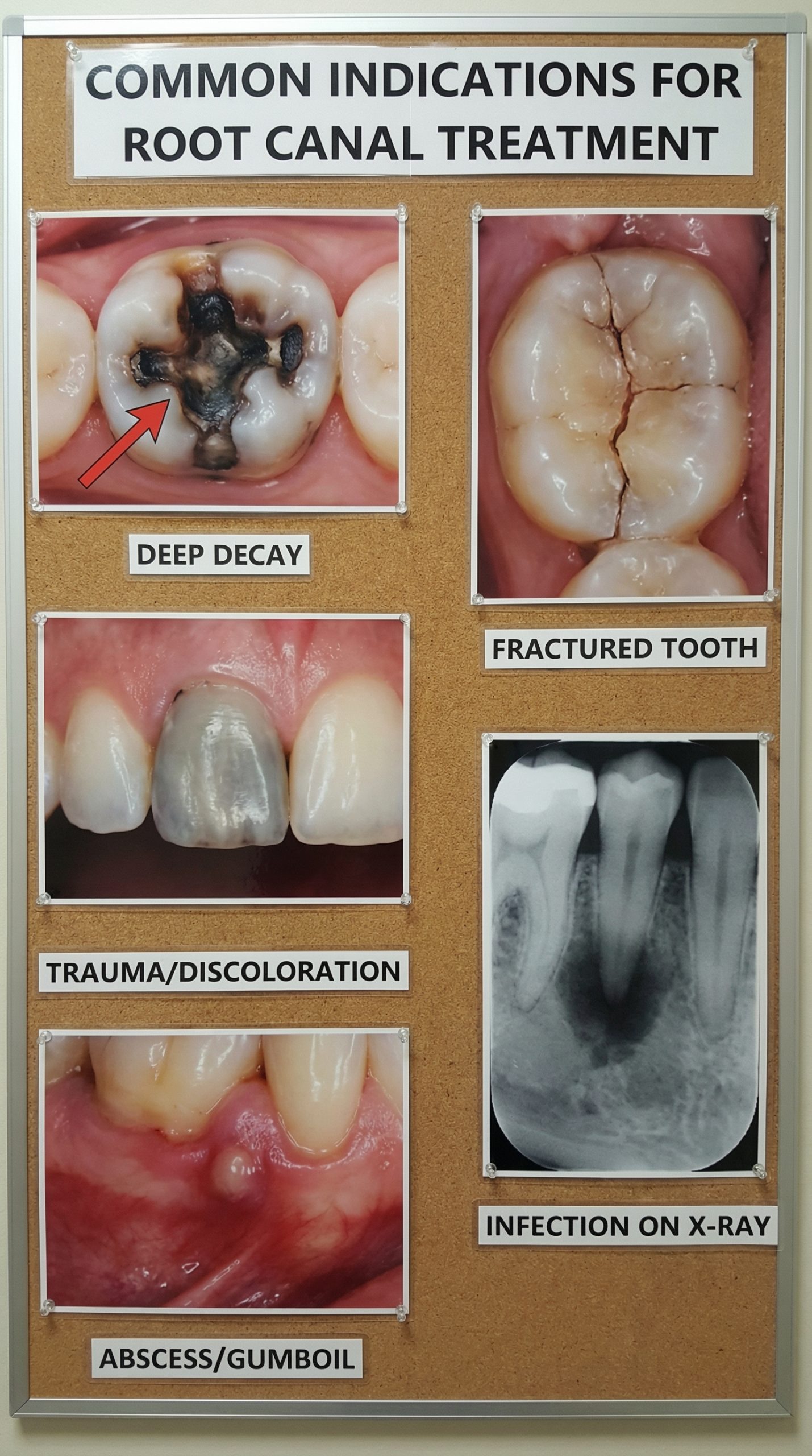 Root canal treatment indications